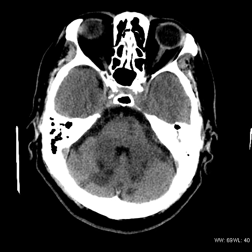 ct brain images