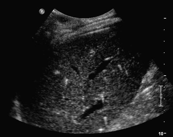 Ultrasound of the liver, biliary tract, and pancreas | Abdominal Key