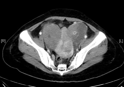 Axial CT scan Fig 1
