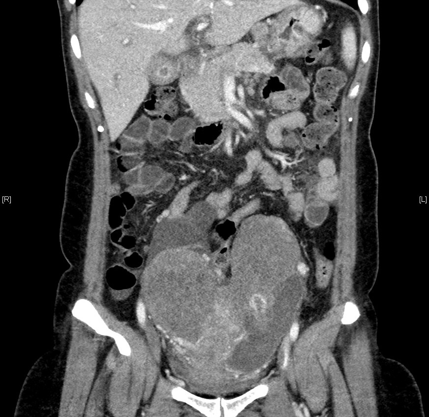 Coronal CT scan Fig 1