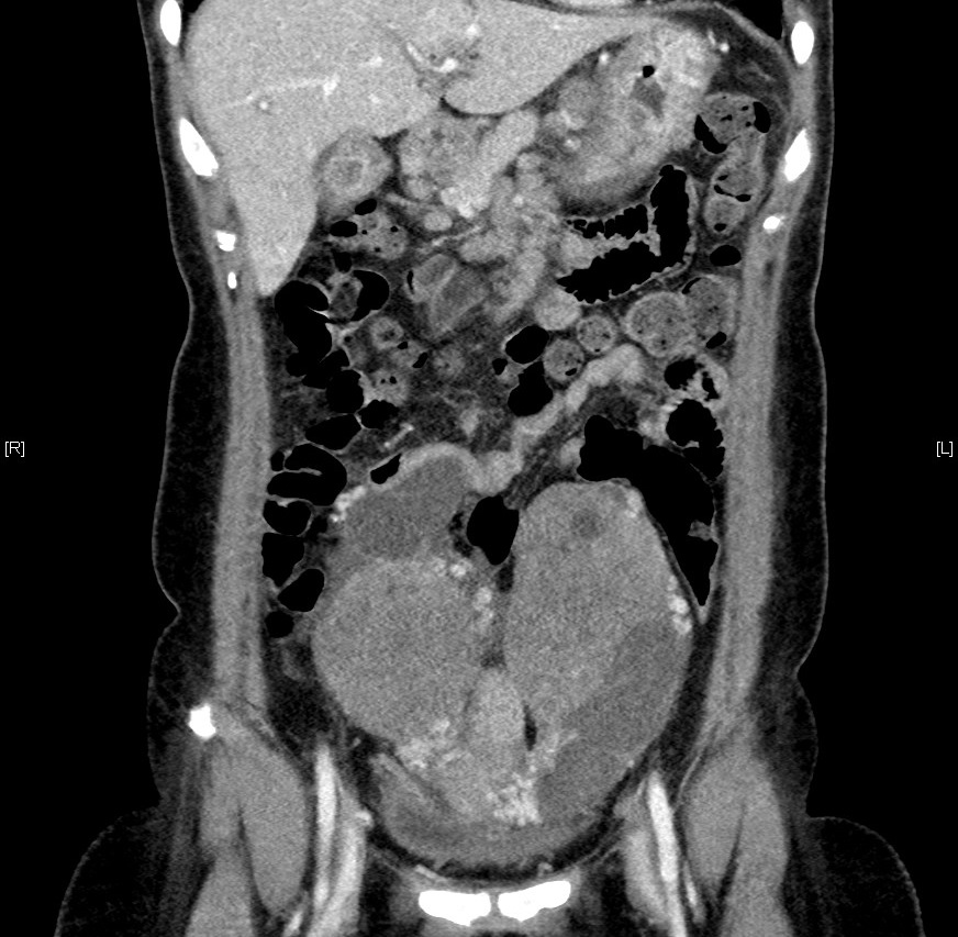 Coronal CT scan Fig 2